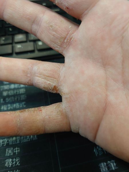 汗皰疹,汗皰疹中醫